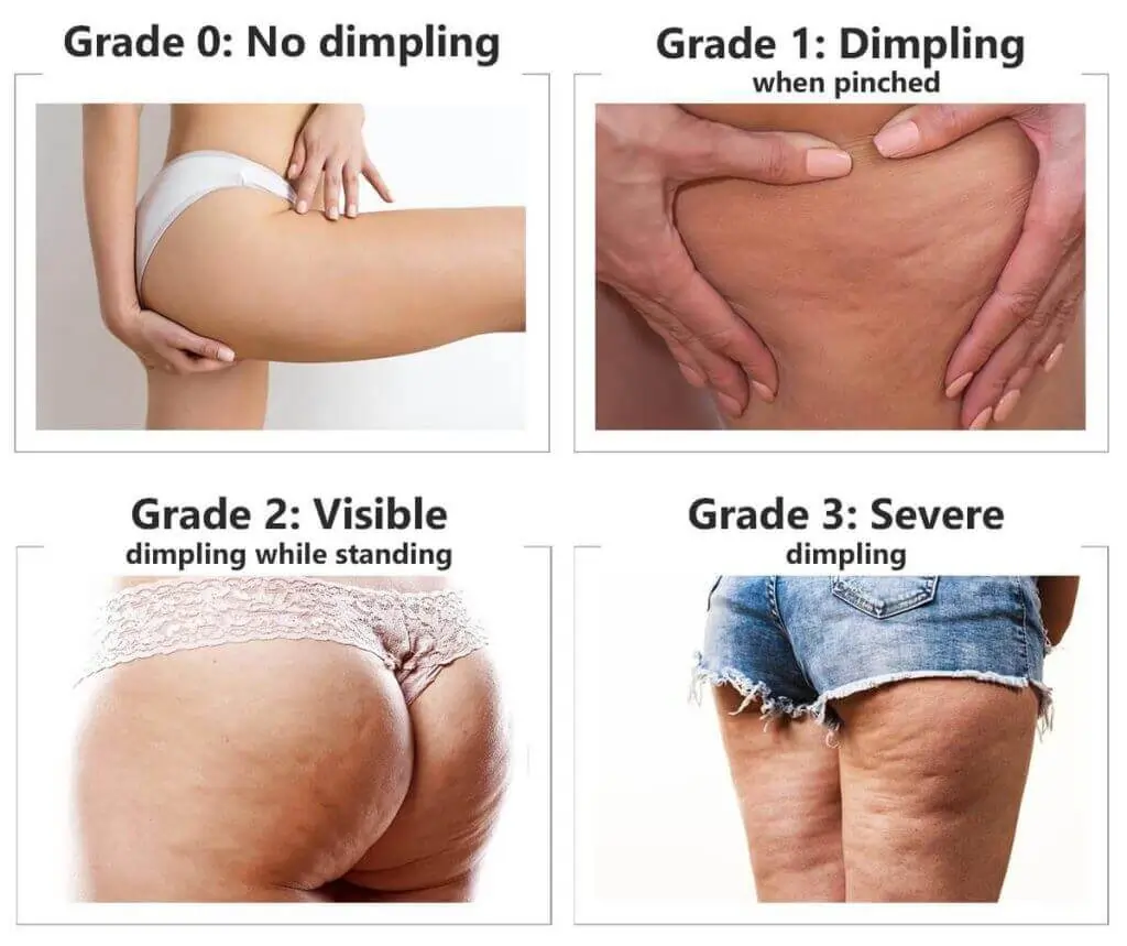 Representation of the stages of cellulite development Ashtead